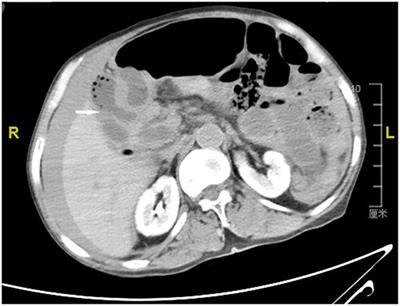 Torsional Necrosis of an Output Loop Internal Hernia After Roux-en-Y Choledochojejunostomy: A Case Report